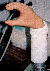 photo of prosthetic hand