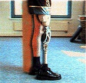 photo of prosthetic knee